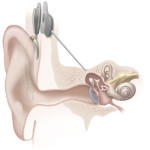 Cochlear_implant