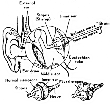 Otosclerosis and stapes surgery — Hearing Institute